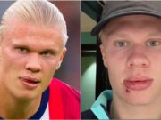 Erling Haaland sofre lesão facial estranha no ônibus da seleção norueguesa