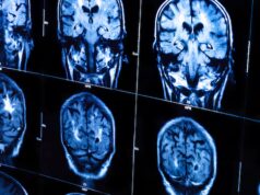 As varreduras cerebrais móveis parecem ficção científica. Mas agora eles estão ajudando mais pacientes canadenses