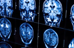 As varreduras cerebrais móveis parecem ficção científica. Mas agora eles estão ajudando mais pacientes canadenses