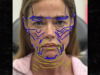 A médica de Denise Richards compartilha fotos antes e depois do lifting facial