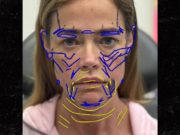 A médica de Denise Richards compartilha fotos antes e depois do lifting facial