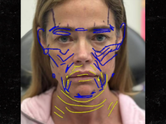 A médica de Denise Richards compartilha fotos antes e depois do lifting facial