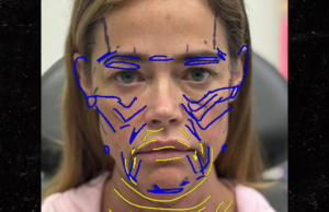 A médica de Denise Richards compartilha fotos antes e depois do lifting facial