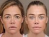 Denise Richards revelou seu facelift e não é uma vitória para a transparência