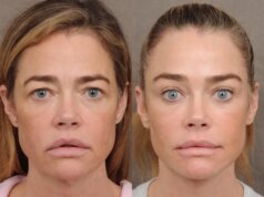 Denise Richards revelou seu facelift e não é uma vitória para a transparência