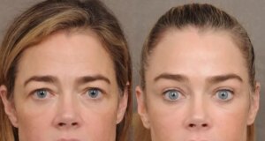 Denise Richards revelou seu facelift e não é uma vitória para a transparência