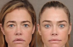 Denise Richards revelou seu facelift e não é uma vitória para a transparência