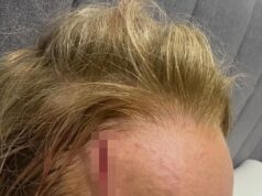 Carrie Bickmore revela um terrível ferimento na cabeça ao sofrer um ferimento horrível em um acidente: ‘Como uma cena de crime’