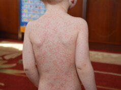 Aquele ataque adolescente de Mono pode ter um segundo ato preocupante