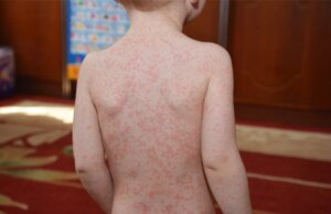 Aquele ataque adolescente de Mono pode ter um segundo ato preocupante