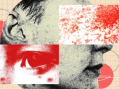 Você precisa ficar mais assustado com herpes zoster