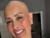 Melanie Sykes exibe com orgulho sua careca dias depois de admitir que perdeu ‘dois terços’ de seu cabelo durante a angustiante batalha contra a alopecia